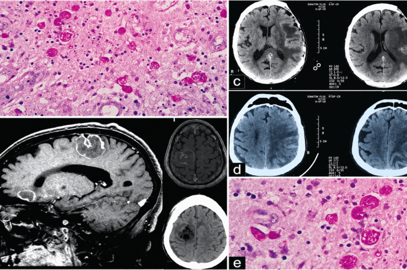 Rare Case of Cerebral Amoebiasis
