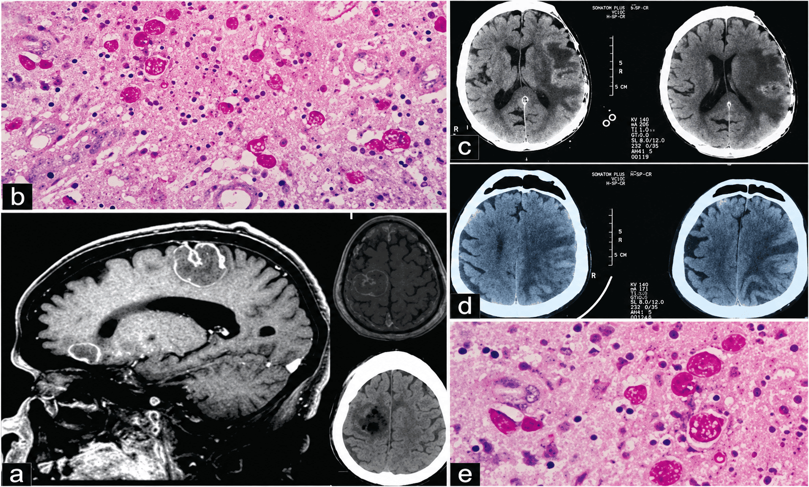 Rare Case of Cerebral Amoebiasis